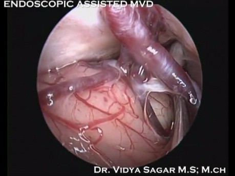Endoscopic Assisted MVD