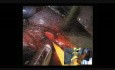 Bronchial management during uniportal left upper lobectomies