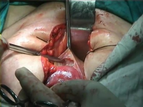 Anatomy of the Pelvis - Vesicocervical Avascular Space