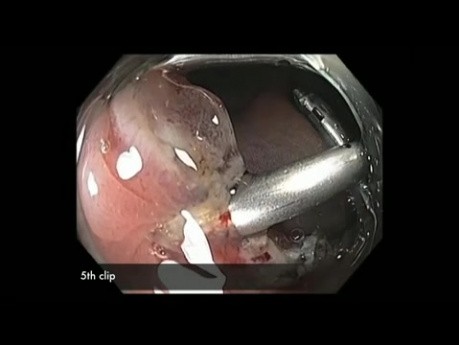 Colonoscopy Channel - EMR Closure 4