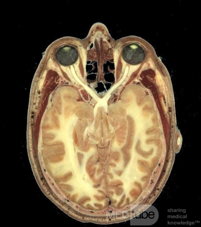 The Relationship Between the Ethmoid Sinuses and the Orbits