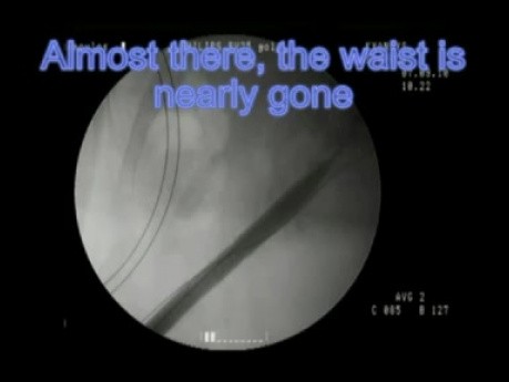 PCNL - Repeated Access/Baloon Failure