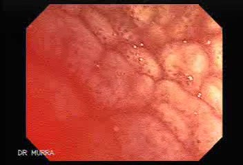 Multiple Adenomatous Polyps Of The Rectum (7 of 37)