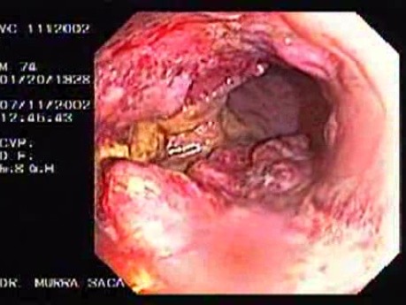 Rectal Adenocarcinoma Emerging From The First Valve (2 of 2)
