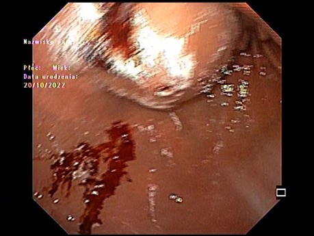 Gastric and Duodenal Submucosal Lesion(s) ... make(s) impression?