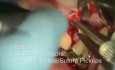Reparation Of Implant - Periodontal Endoscopy And Microsurgery