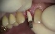 #7 Immediate Implant And Provisional