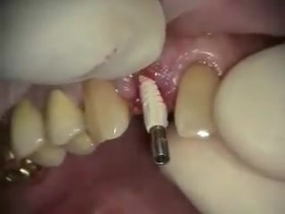 #7 Immediate Implant And Provisional