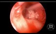 Cholesteatoma Resection by Endoscopic and Microscopic Approach