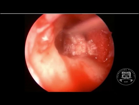 Cholesteatoma Resection by Endoscopic and Microscopic Approach