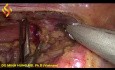 Thoraco-Lap Esophagectomy - Thoracic Part 3