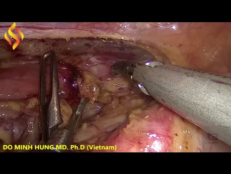 Thoraco-Lap Esophagectomy - Thoracic Part 3