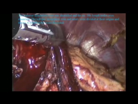 Laparoscopic D2 Radical Total Gastrectomy for Gastric Cancer