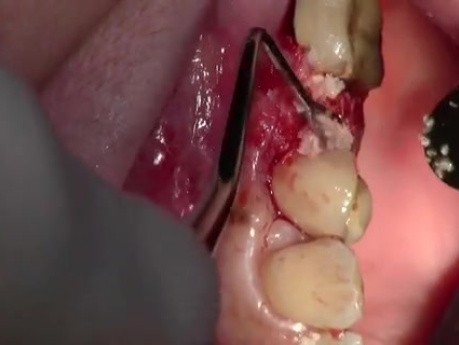 Extraction #13 With Simple Socket Bone Grafting