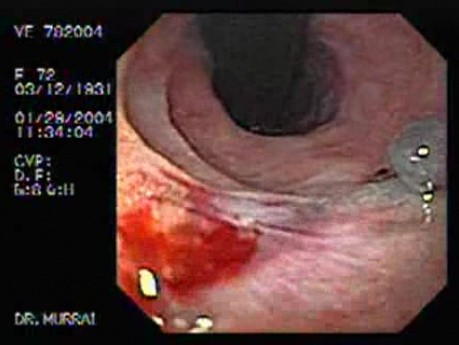 Mallory-Weiss Syndrome - Closer Look at the Blood Clot, Part 1