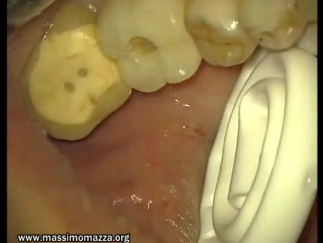 Loading Of Early Prosthesis 16-17-25-26-27 (3/3)