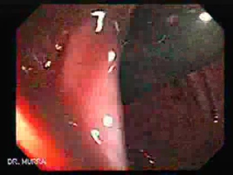 Massive Rectal Bleeding (9 of 11)