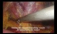 Renal‑rotation Techniques in Retroperitoneoscopic Adrenalectomy for Giant Pheochromocytomas (right sided)