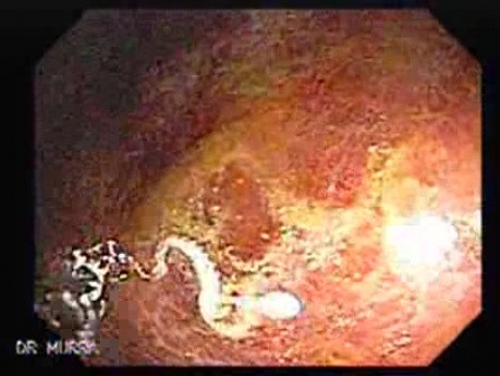 Schistosoma Mansoni (2 of 9)