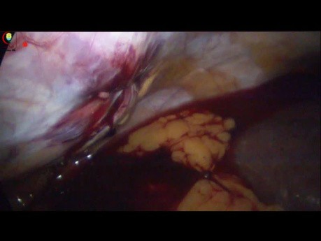 Nasr Fascial Closure Can Control Port Site Bleeding