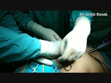 How to Remove Big Ovarian Cyst by Laparoscopic Port