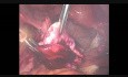 Ovarian Cystadenoma