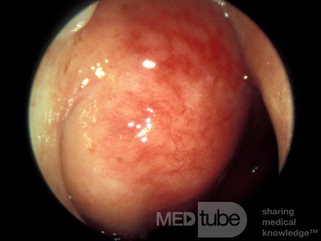 Carcinoma of the Nasopharynx