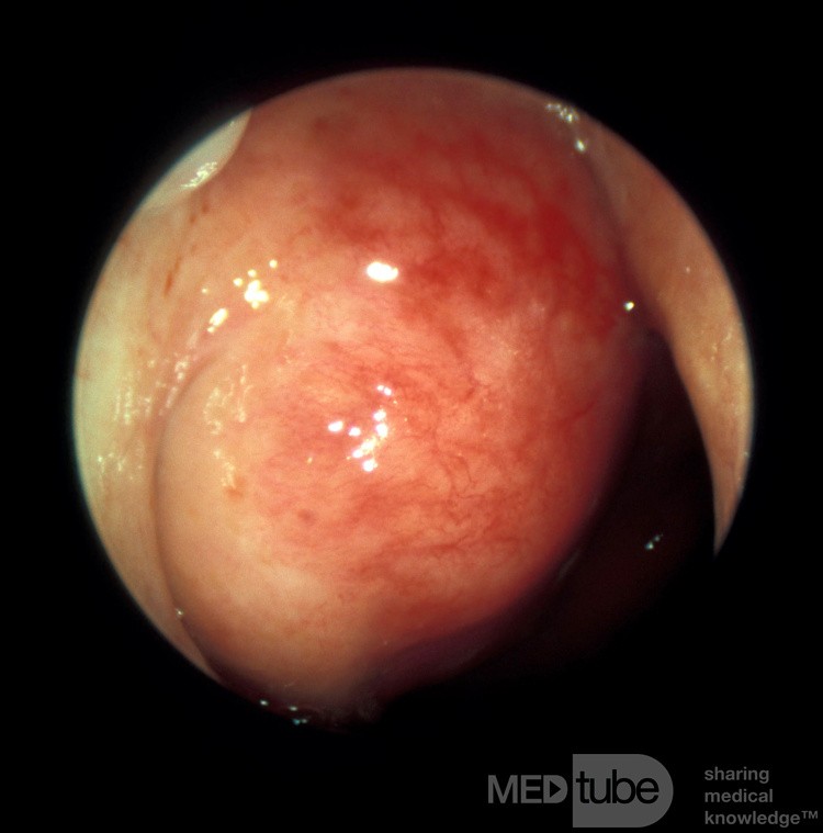 Carcinoma of the Nasopharynx