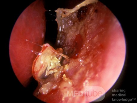 Chronic Bacterial Rhinitis