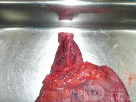 Adenocarcinoma of the cardias and gastric fundus with signet-ring cells (8 of 25)