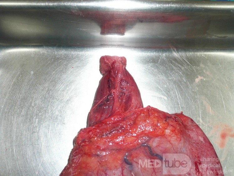 Adenocarcinoma of the cardias and gastric fundus with signet-ring cells (8 of 25)