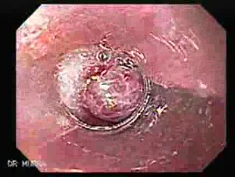 Hemorrhage After Ligation - Banding of Esophageal Varices with Red Spot