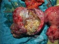 Cancer Ovary Radical Surgery, 2