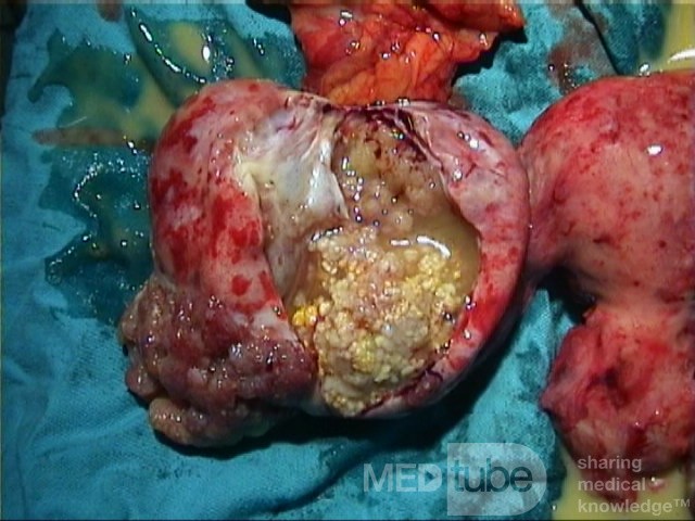 Cancer Ovary Radical Surgery, 2