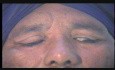 Total Transplantation of Superior Rectus for Complete Ptosis