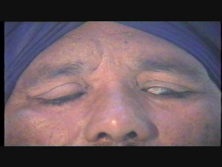 Total Transplantation of Superior Rectus for Complete Ptosis