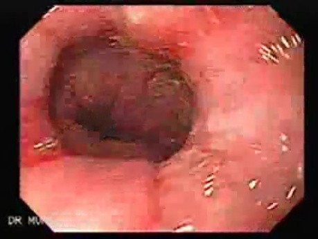 Synchronous Cancer Gastric and Esophageal (5 of 9 )