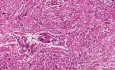 Metastatic leiomyosarcoma - Histopathology - Lung
