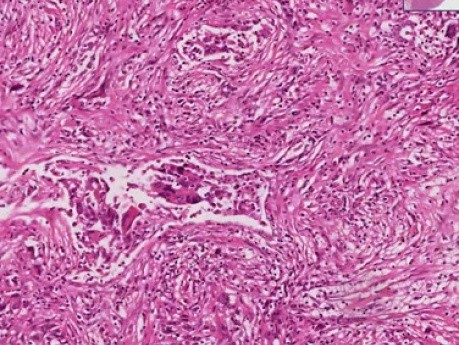 Metastatic leiomyosarcoma - Histopathology - Lung
