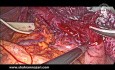 Long Myotomy for Achalasia
