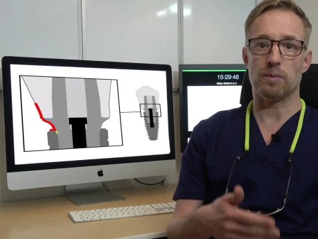 The Implant Supracrestal Complex - International Journal of Prosthodontics
