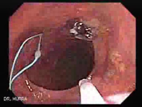 Huge Mass Of The Descending Colon (13 of 25)