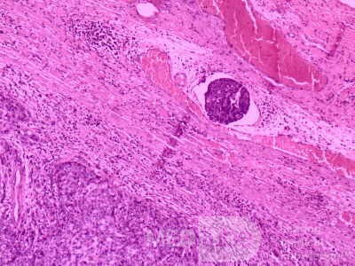 Gallbladder Adenocarcinoma and litiasis (9 of 13)