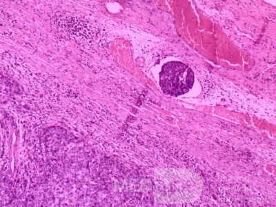 Gallbladder Adenocarcinoma and litiasis (9 of 13)