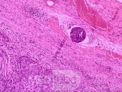Gallbladder Adenocarcinoma and litiasis (9 of 13)