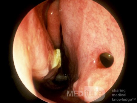 Small Nasal Septal Perforation Post Septoplasty