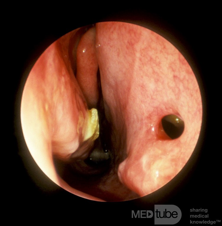 Small Nasal Septal Perforation Post Septoplasty