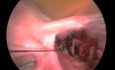 Laparoscopis Myomectomy Followed by Ligation of Uterine Artery