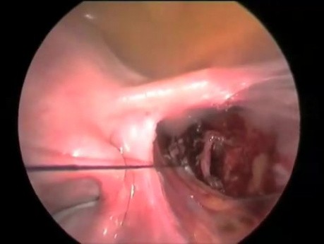 Laparoscopis Myomectomy Followed by Ligation of Uterine Artery