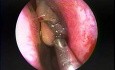 Nasal Polypectomy - Endoscopy 